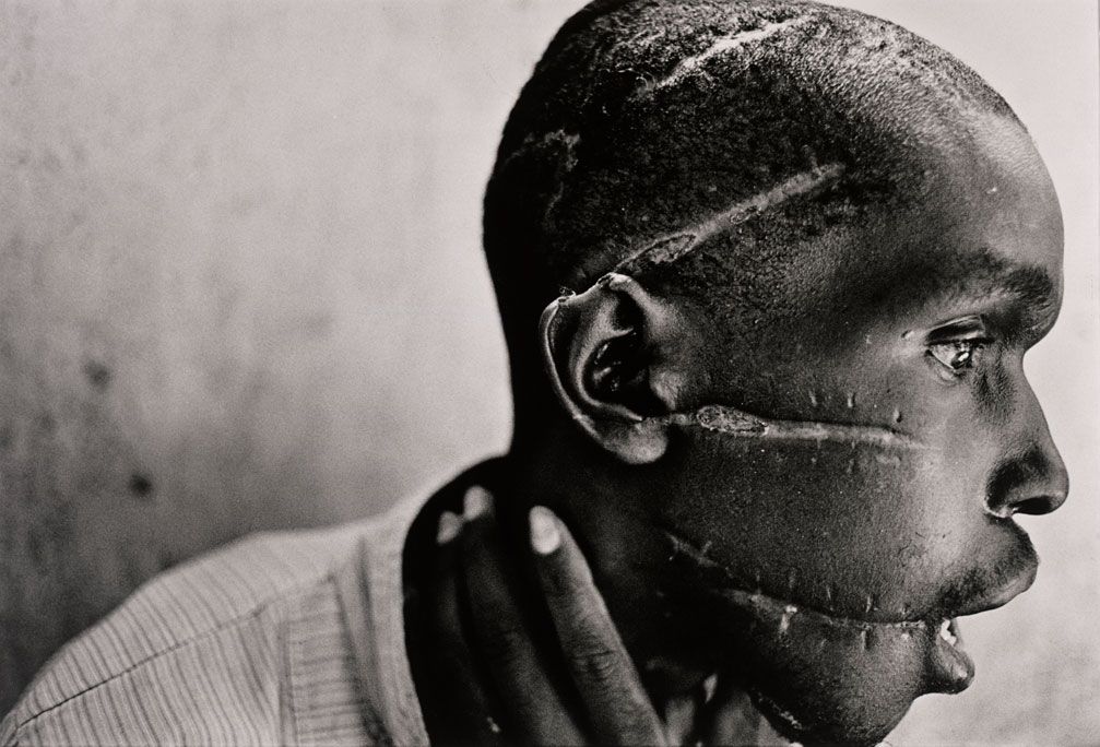 Изуродованный человек в Руанде
